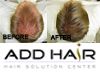 ผมบาง ผมร่วง ศีรษะล้าน ปรึกษาแอดแฮร์ Phuket Non-Surgical Hair Replacement