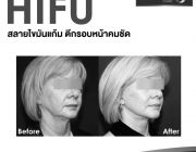 โปรโมชั่น ultra hifu ยกกระชับหน้า ไดเมนชั่นคลินิก โปรโมชั่น ยกกระชับ ปรับหน้าเร